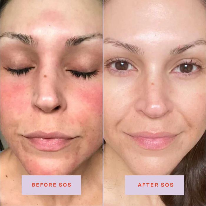 A before and after shot of a person using the spray, showing noticeable reduction in facial redness after use.