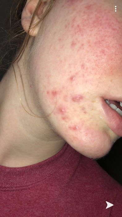 A reviewer shows redness and acne on their skin before using the product.