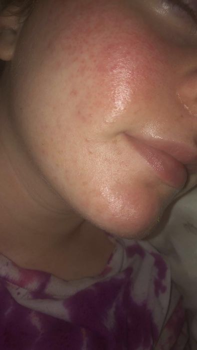 The same reviewer with visibly clearer, more hydrated skin after using the product.