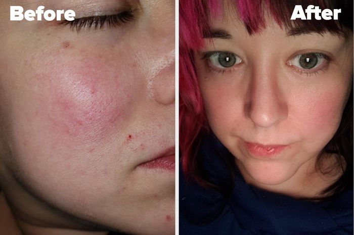 A side-by-side comparison of the reviewer’s red skin next to their skin with visibly reduced redness after using the product.