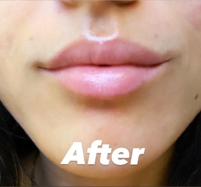 Jasmin the next morning, sporting visibly softer and fuller lips