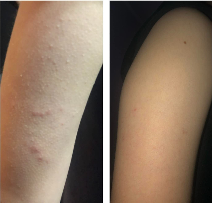 Before and after images showing how the body wash completely cleared up the reviewer's arm bumps and breakouts
