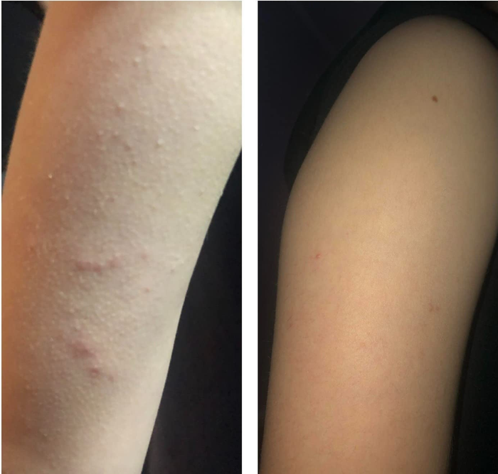 Before and after pictures showing how the body wash cleared up the reviewer's arm bumps and breakouts completely.