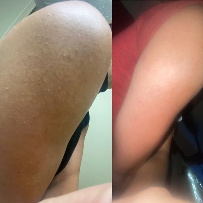 The reviewer’s skin before and after using the bump eraser