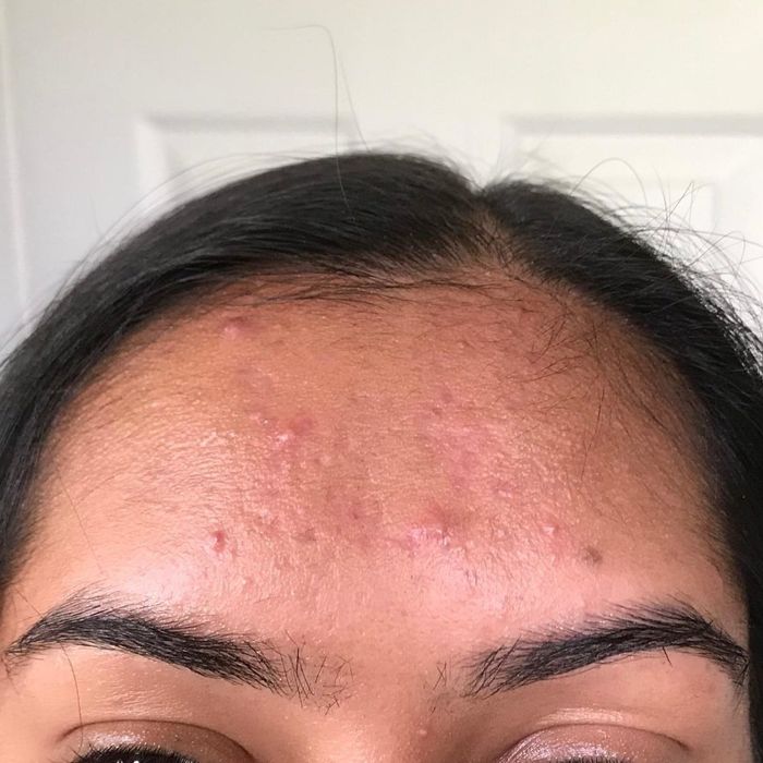 The same reviewer's forehead after using the sheets, revealing a much less oily appearance.