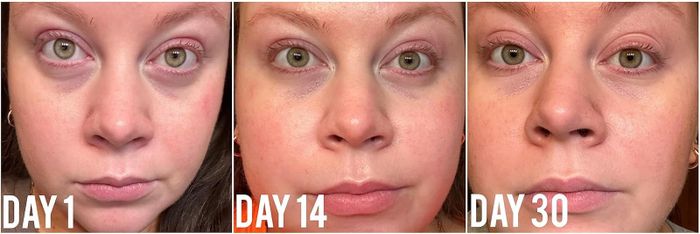 A side-by-side comparison of a user’s dark eye circles on day 1, showing notable improvement by day 14, and even clearer results on day 30.