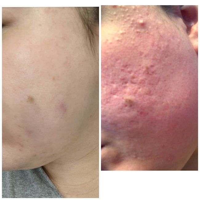 A reviewer's before/after demonstrating improved skin with less redness, smoother texture, fewer acne breakouts, and diminished scarring