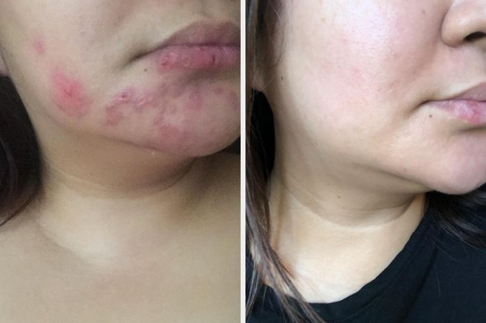 A reviewer showing their acne scars with a follow-up image showing the scars noticeably faded.