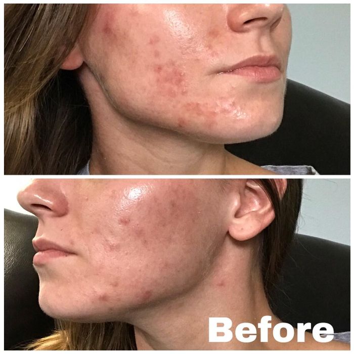 Before using the cream, the reviewer’s skin appears uneven and textured.
