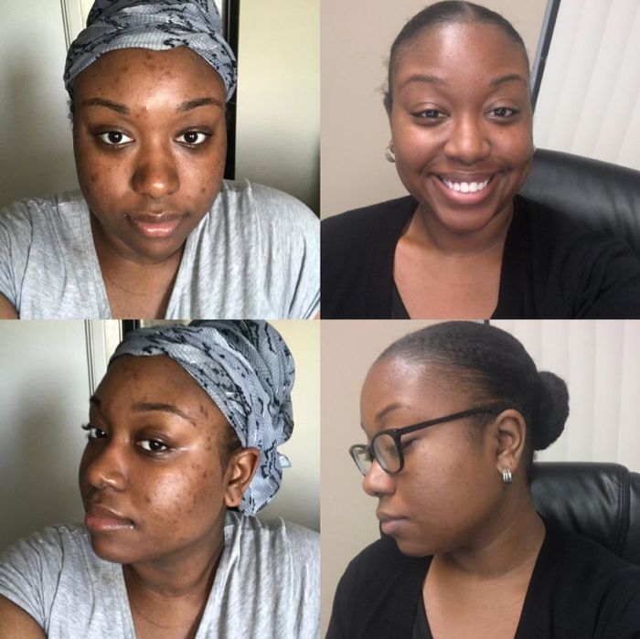 A reviewer with deep skin tone demonstrating how the serum significantly faded acne scars on their forehead and cheeks
