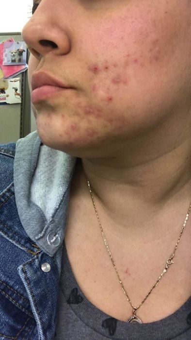 A reviewer's cheek and jawline showing acne