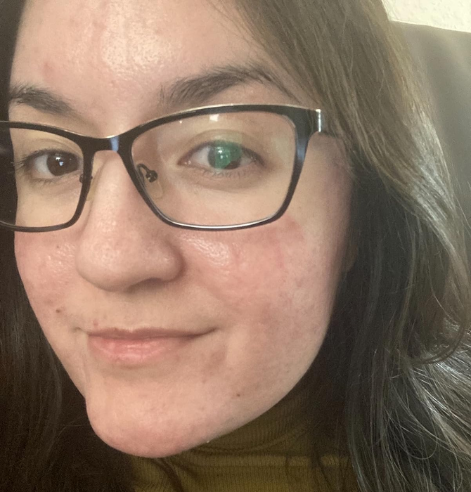 Reviewer showing visibly clearer skin after using the face wash