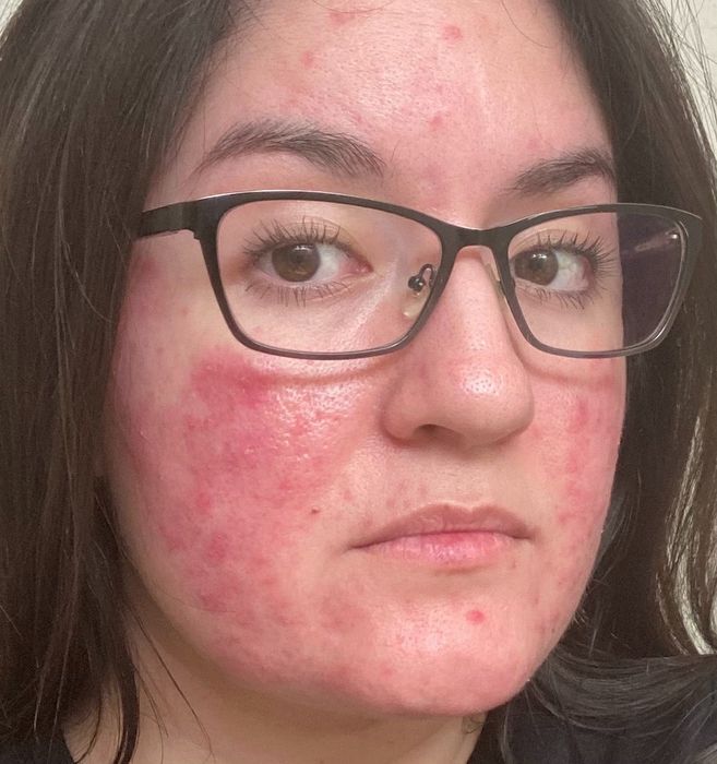 Reviewer showing acne before using the face wash