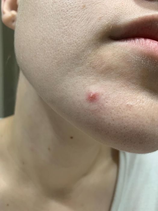 A reviewer with a pimple on their face