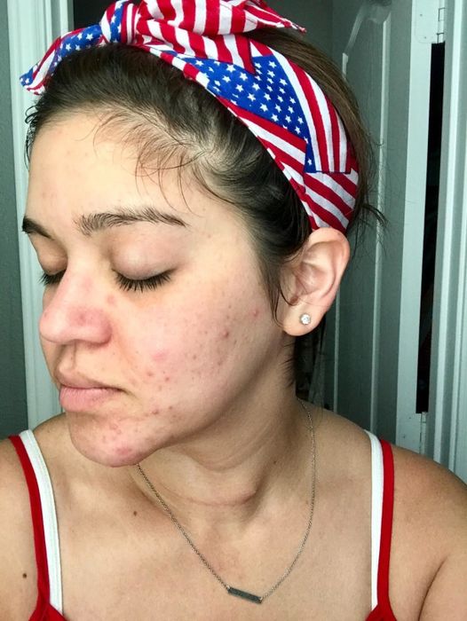 A reviewer displaying acne on their cheek and jawline.