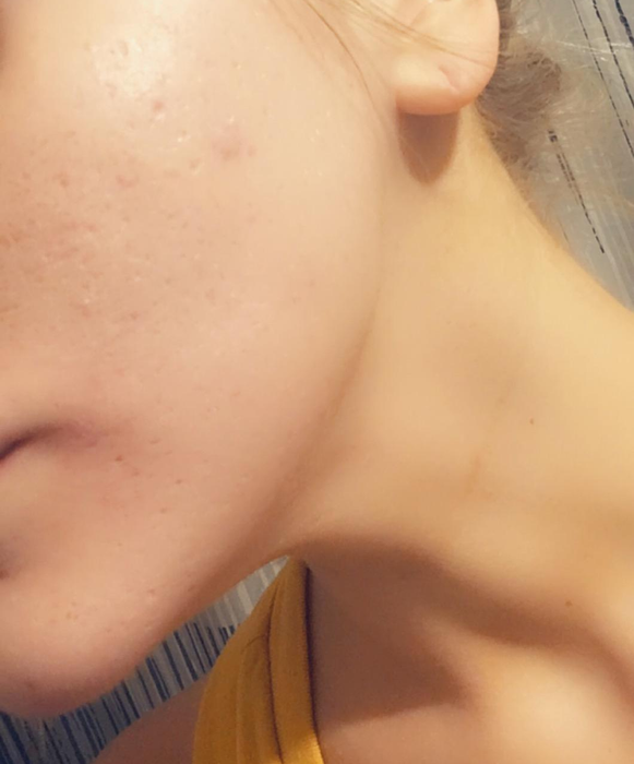 Reviewer’s after photo showcasing smooth, even skin with reduced acne