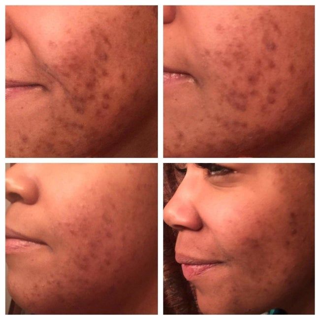 A set of four images featuring a reviewer showcasing the healing of acne and fading of acne scars.