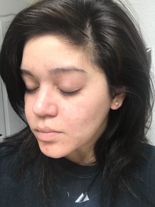 The same reviewer showing significant improvement with much clearer skin.