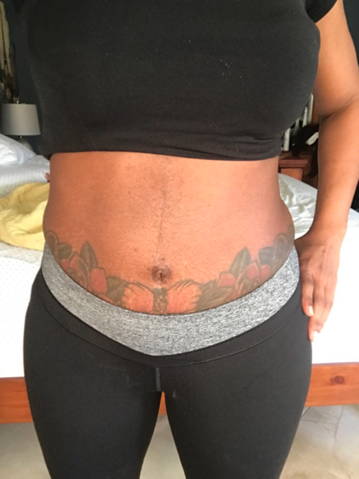 Bio-Oil reviewers showcasing stomach tattoos that remained visible post-pregnancy, highlighting the oil's effectiveness.