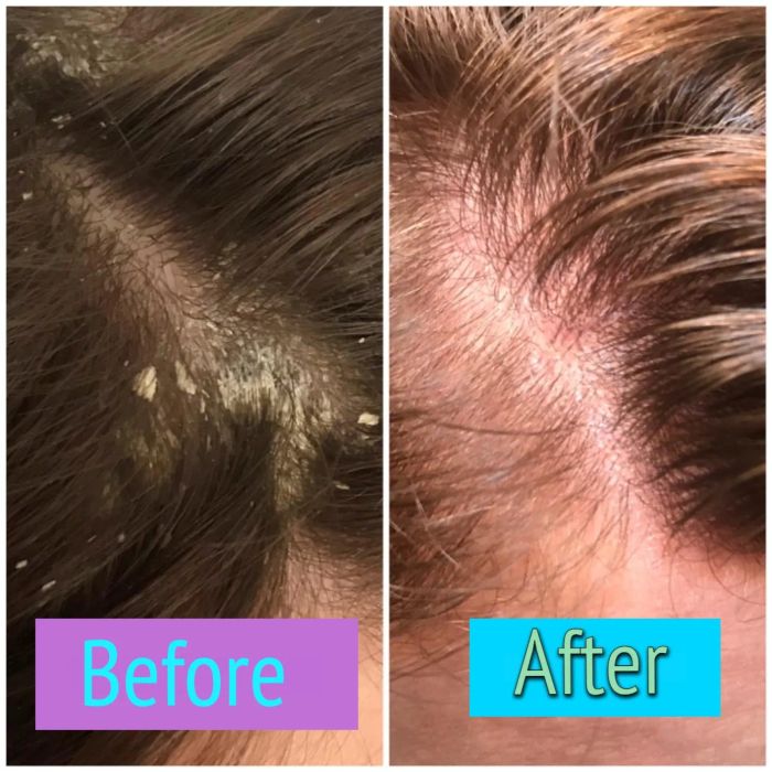 a before and after demonstration of the dandruff shampoo's effectiveness
