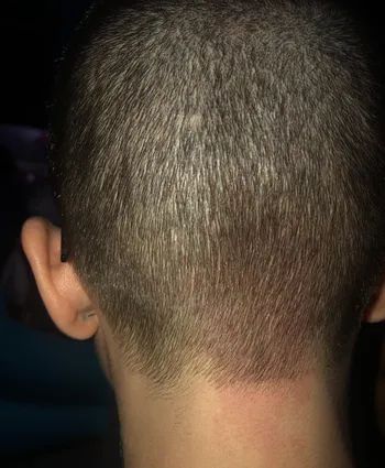 a reviewer's scalp appearing less red and irritated after using the brush