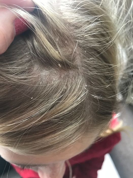 A reviewer demonstrates a scalp affected by dandruff.
