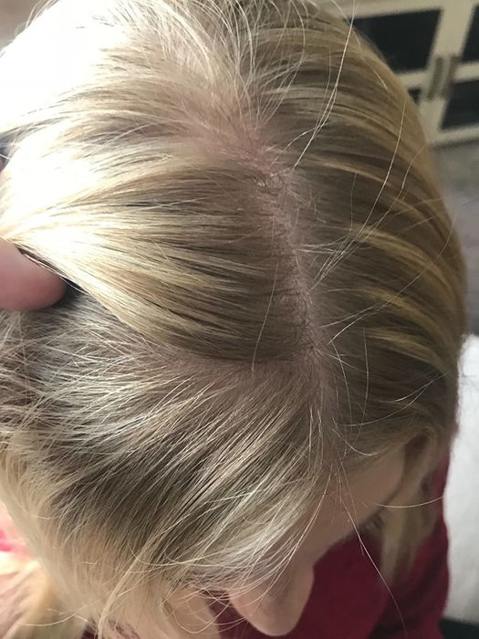 A reviewer displays a dandruff-free scalp after consistent use of the product.