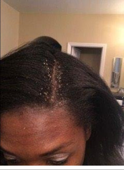 A reviewer's scalp with visible dandruff flakes near their part