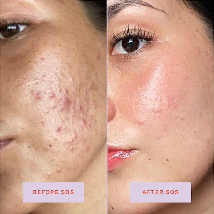 A before-and-after showing the healing of a breakout after using the SOS spray