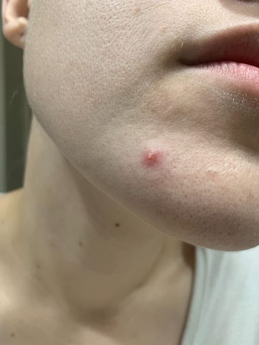 The reviewer's chin featuring a prominent pimple, with a pimple patch applied on top.