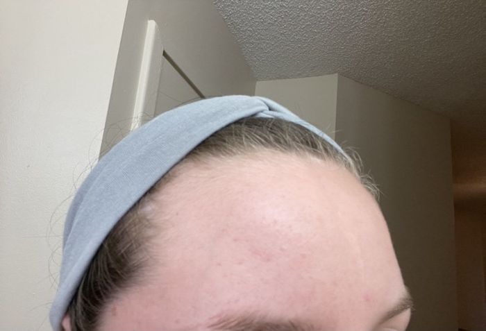 A reviewer's forehead after applying this product