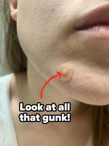 The same reviewer, but now the pimple patch has developed a white center.