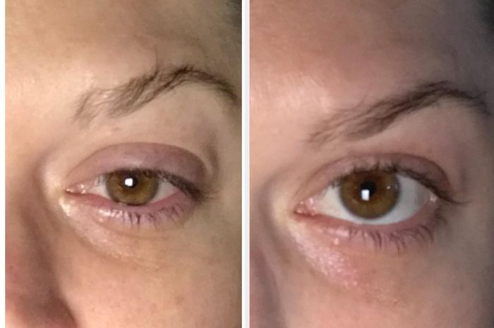 Before and after shots of the reviewer's eyes, showing reduced puffiness after using the ice roller.