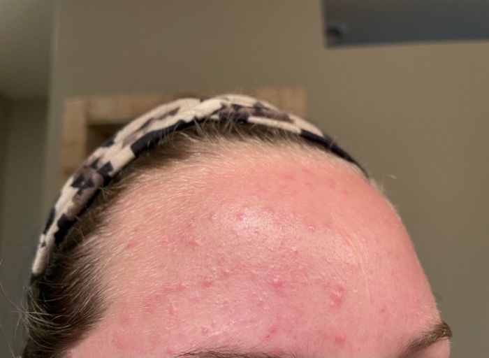 A reviewer's forehead before applying this product