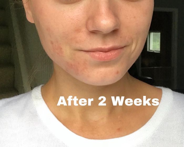 The reviewer's clearer-looking skin after two weeks of using the cream