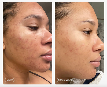 A model's before-and-after photos showing acne and redness on the left and significantly clearer skin on the right
