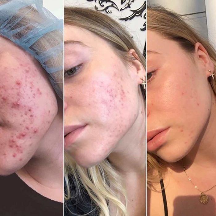 A model displaying a progression from noticeable acne on the left, moderate acne in the center, to almost clear skin on the right
