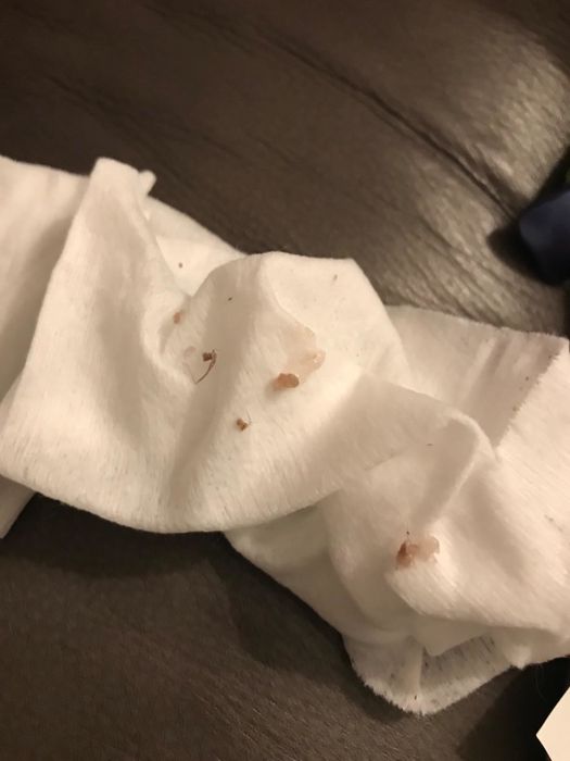 A photo from the reviewer displaying the eye boogers they collected on a tissue.