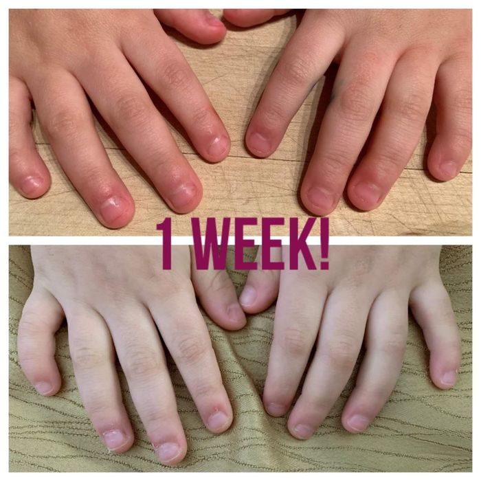 Before-and-after photos from a reviewer showing their child's nails: the first image displays bitten nails, while the second reveals significant improvement after a week of using the pen.