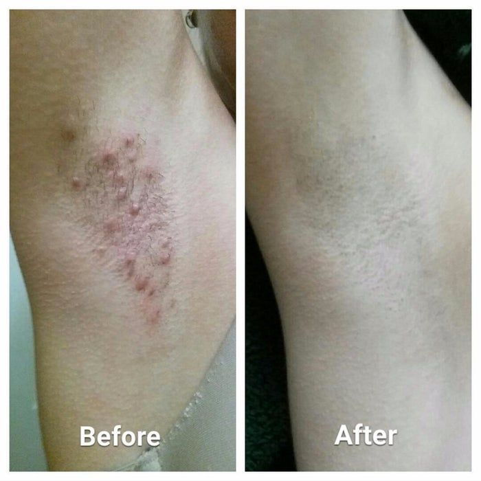 Before-and-after photos from reviewers showing the success of an ingrown hair treatment that reduced razor bumps and ingrown hairs in their underarms
