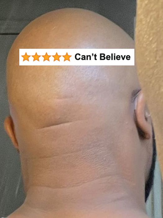 A close-up photo of a person’s shaven head from the back, focusing on the scalp and ear area.