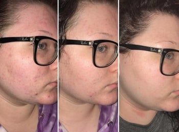 progression photo showing the reviewer’s acne fading as they continue using the serum