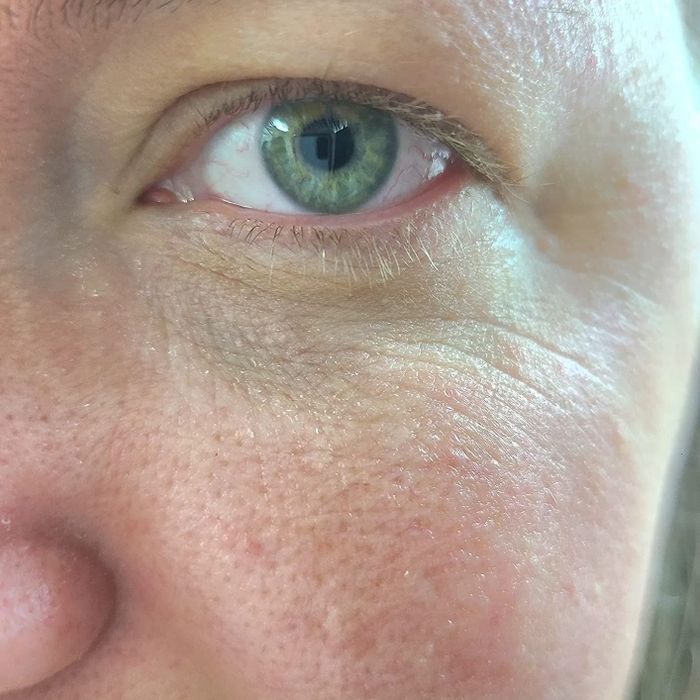 Reviewer’s before shot, showing dark under-eye skin prior to using the eye cream