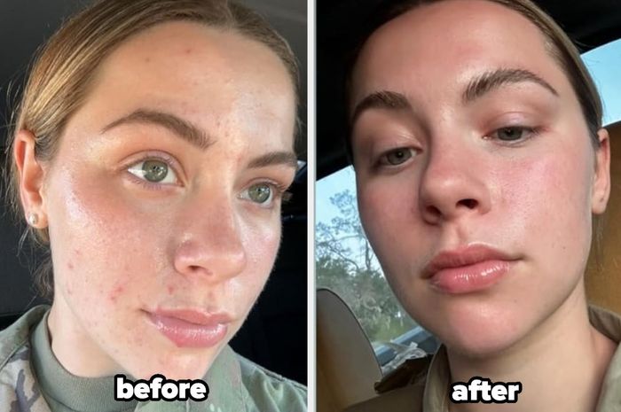 Close-up of a person's face showcasing noticeable skincare results.
