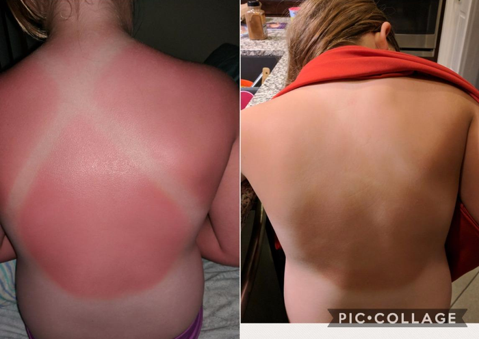before and after images showing the reviewer’s sunburned back becoming noticeably less red after using the lotion