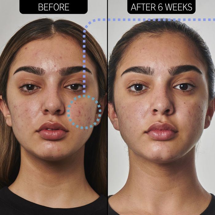 Before and after image of a model using the cleanser, six weeks apart