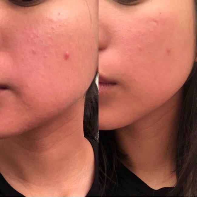 Reviewer’s skin appears red and bumpy in the before picture, then smoother and clearer with reduced pimples in the after shot after using the roller.
