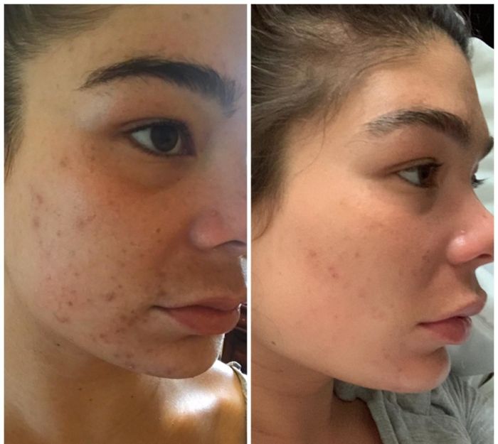 A split image showing a face with red bumps and acne scars on the left side, and the same face with visibly fewer bumps and scars on the right side.