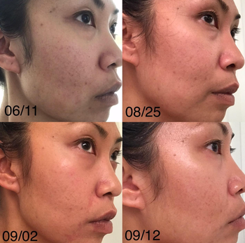 Reviewer’s skin progress photos showing gradual improvement and clearer skin over time.