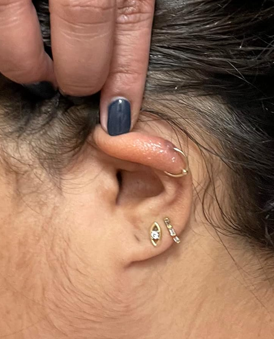 The same reviewer's ear after using the keloid treatment daily, with the bump reduced.